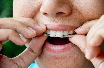 retainer removal, dental care